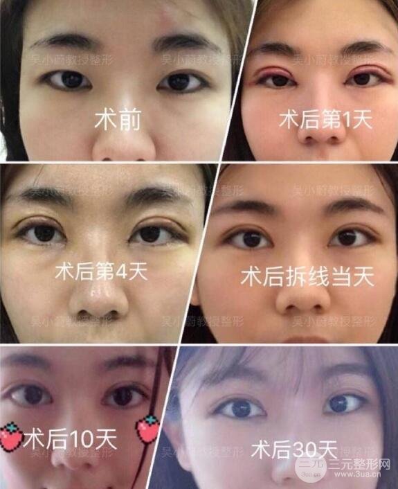 一般做双眼皮多少钱?贫民窟女孩能hold住吗?