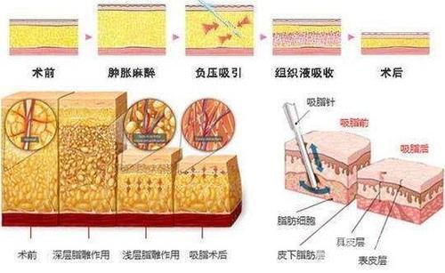吸脂失败后还可以修复吗?小编为你揭秘!