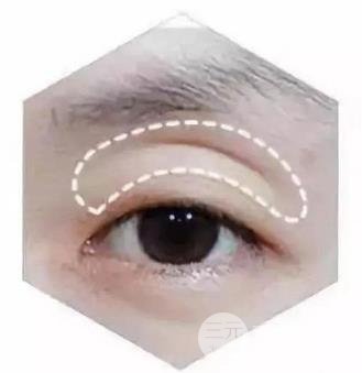 眼窝填充的方式