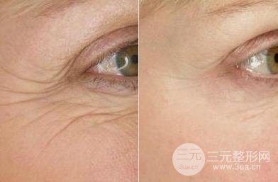 去鱼尾纹