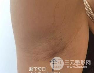 腋窝切口