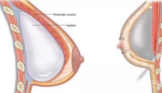 乳晕切口