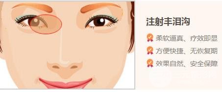玻尿酸填充泪沟维持的时间