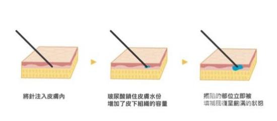 玻尿酸填充泪沟后多久能恢复?