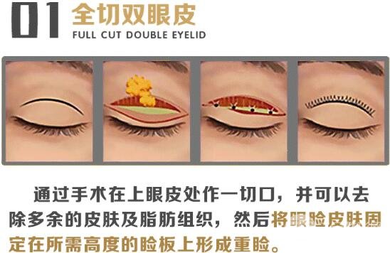 微创全切双眼皮多久恢复自然？这件事别忘了做！