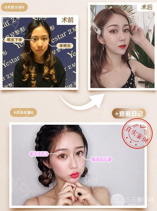 微创全切双眼皮案例图