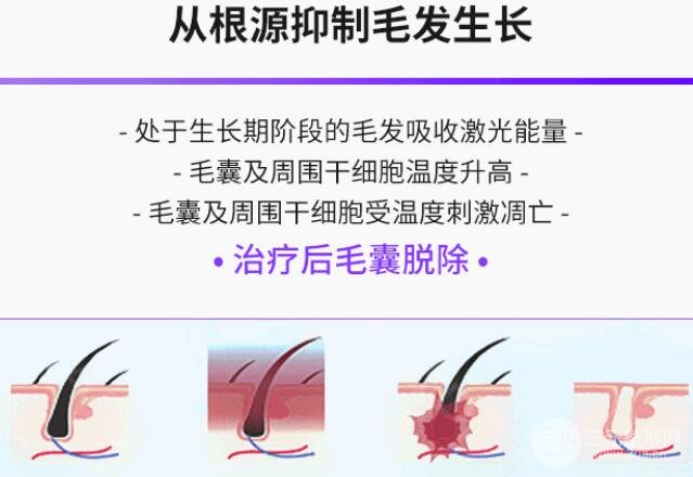 冰点脱毛怎么样?光滑无暇肌肤就靠它!