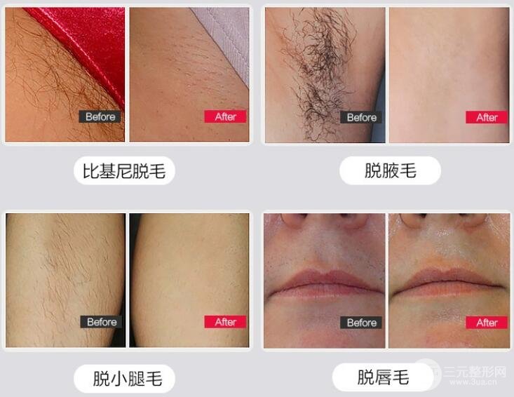 冰点脱毛果图