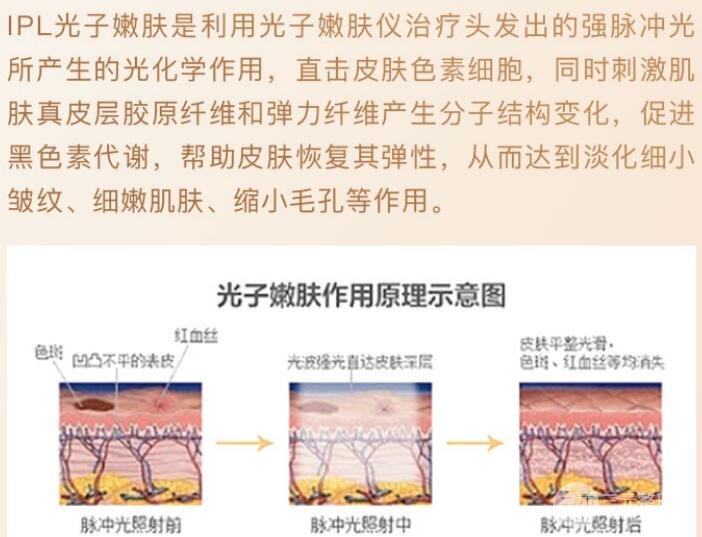 北京光子嫩肤果怎么样