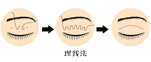 双眼皮手术方法