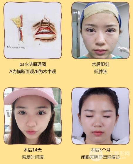 做双眼皮手术有风险吗?