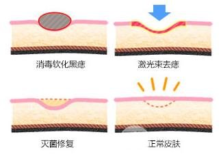 激光点痣后的注意事项