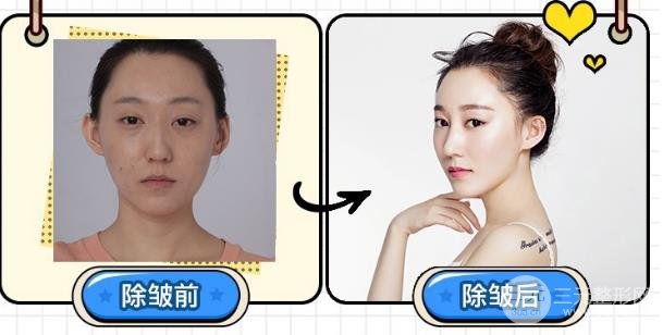 激光去除抬头纹很有果