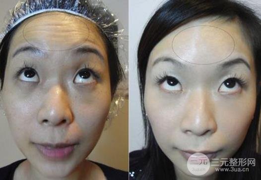 其他方法去除抬头纹