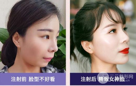 玻尿酸丰下巴维持的时间