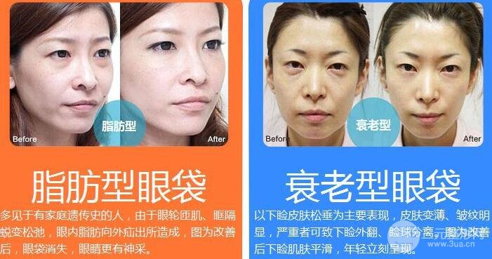 去眼袋