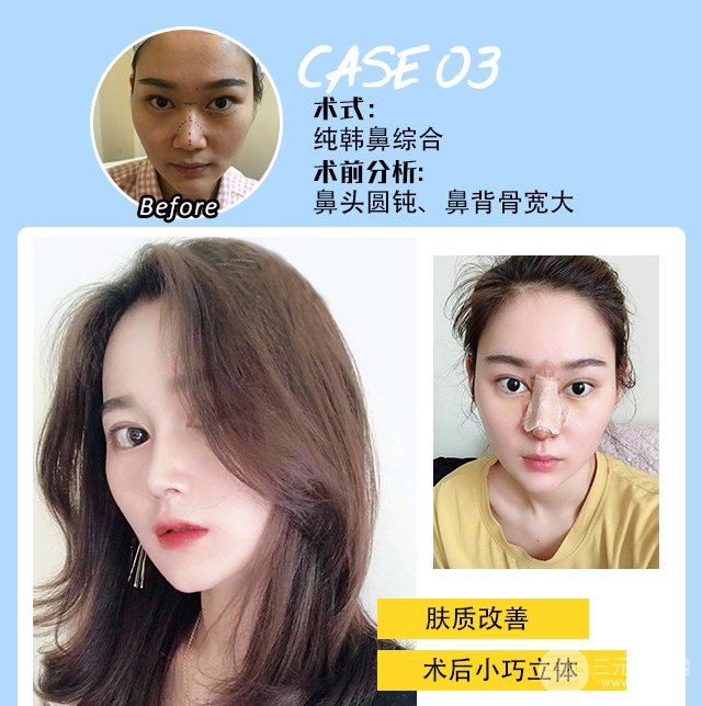 膨体隆鼻果图