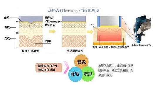 热玛吉工作原理