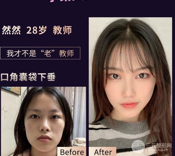 热玛吉的缓解过程