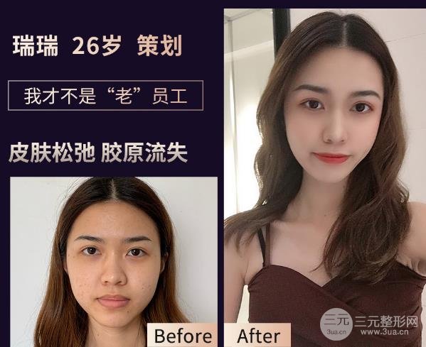 热玛吉的缓解过程