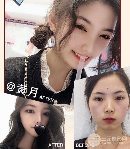 做完冷冻去痣的注意事项