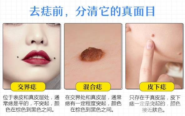 冷冻去痣的价格