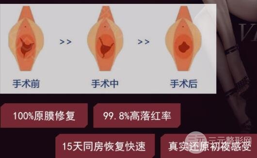 处女膜修补术术后注意事项！