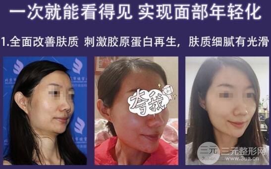 面部除皱热拉提果好不好