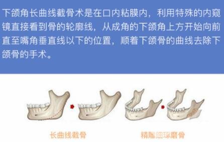 削骨瘦脸手术