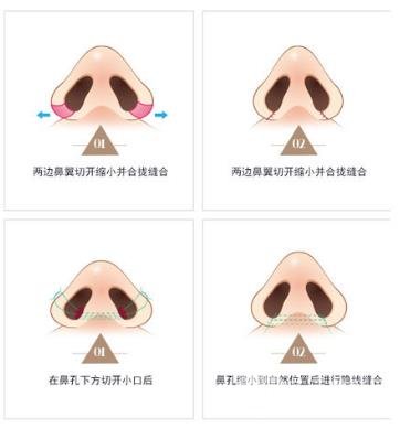 鼻翼缺损矫正手术适应的人群