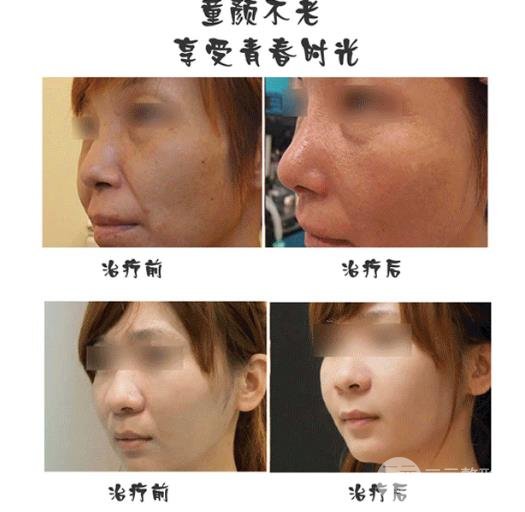 热玛吉紧肤注意事项