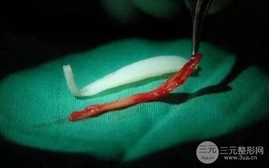 隆鼻硅胶取出后鼻子会变丑吗?