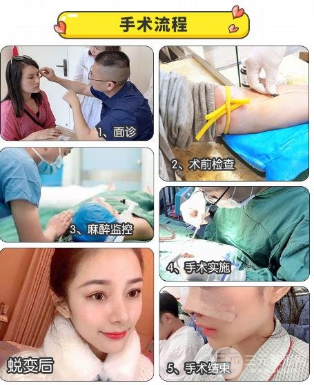 硅胶隆鼻的特点