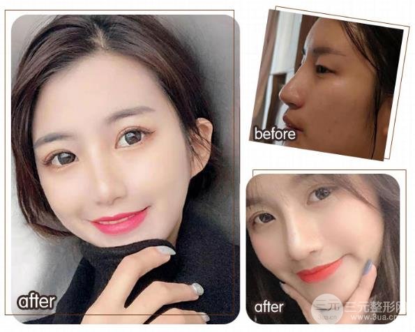 硅胶隆鼻的特点