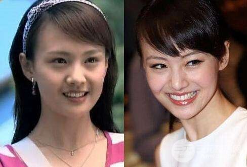 削骨手术多少钱?价格=果,值!