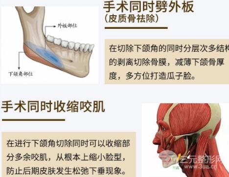 削骨手术多少钱?价格=果,值!