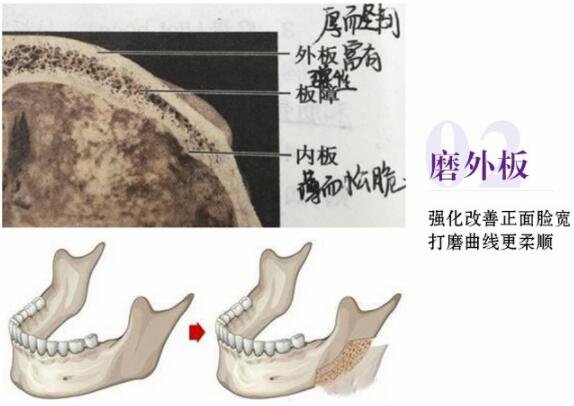 磨腮削骨多少钱?别怕贵,降低风险才重要!