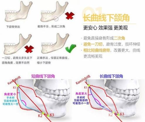 磨腮削骨多少钱?别怕贵,降低风险才重要!