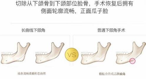 磨腮削骨多少钱?别怕贵,降低风险才重要!