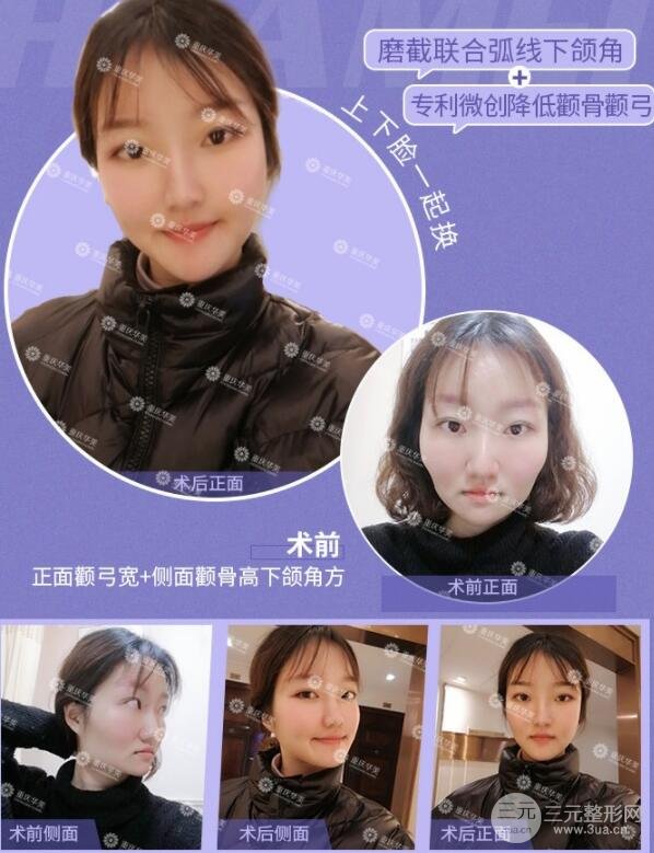 磨腮削骨多少钱?别怕贵,降低风险才重要!