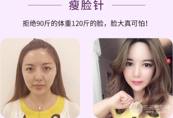 注射瘦脸案例