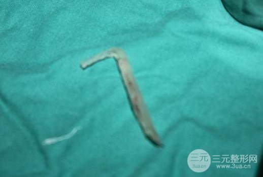 鼻梁假体取出术介绍