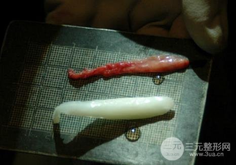 什么时候需要将鼻梁的假体取出?