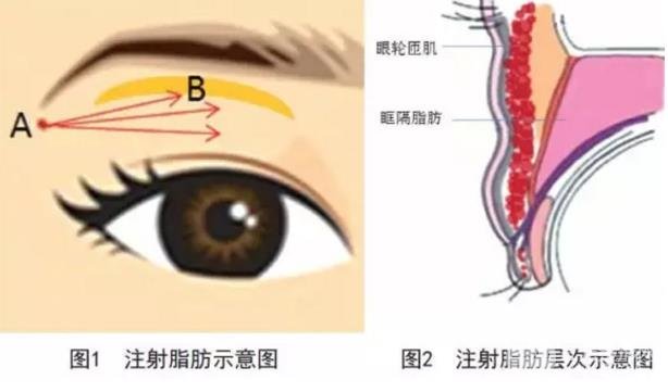 眼窝凹陷出现的原因