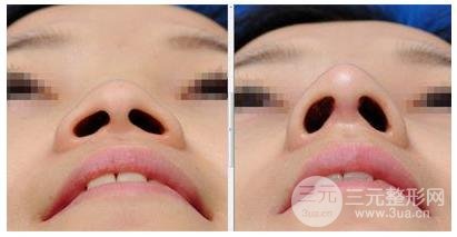 垫鼻子鼻尖手术常用的材料