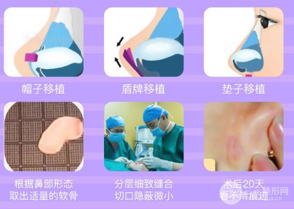 垫鼻子鼻尖手术适用的人群