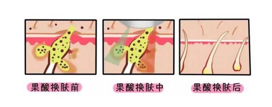 果酸换肤需要多少钱 肌肤的重生之路~