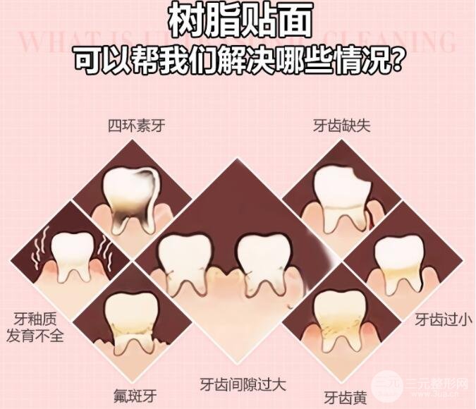 上海九院牙齿贴面技术好不好