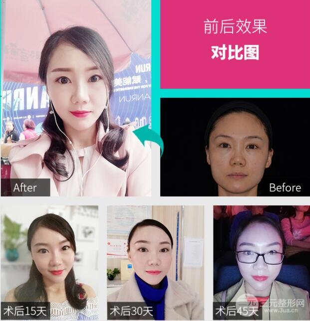 激光溶脂瘦脸会反弹吗 果图