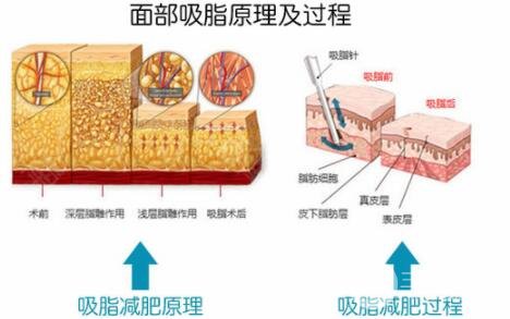 脸部吸脂价格贵不贵,大脸妹们看过来~
